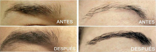 Antes y después del uso de EvoEye para cejas