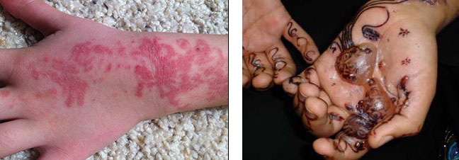Reacciones al tatuaje de henna negra. Foto: AEMPS